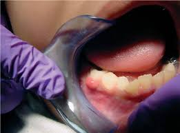 This early stage of gum disease is known as gingivitis. Focal Gum Lesions Visual Diagnosis And Treatment In Pediatrics 3 Ed