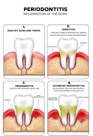 gum disease causes care and treatment