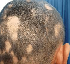 Hair loss (alopecia) can affect just your scalp or your entire body, and it can be temporary or permanent. Alopecia Areata Walk In Dermatology