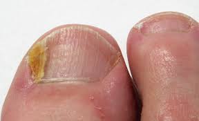 what causes fungal nail infection