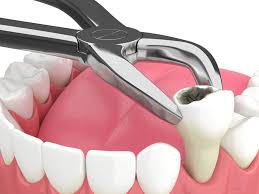 tooth extractions procedure