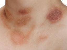 rash on inner thigh 12 causes