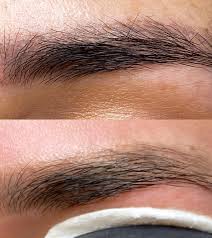 needle brow tattoo removal