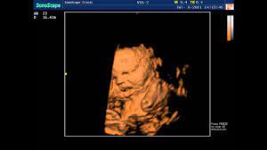 sonoscape s8 color doppler ultrasound