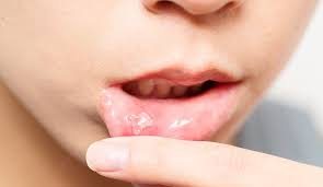 12 best treatments for canker sores