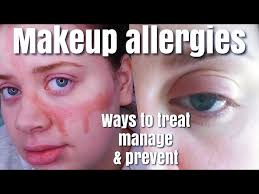 heal allergic reactions to makeup on