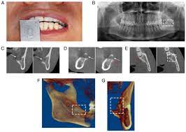 mandibular third molar extraction