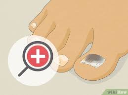 how to treat toenail fungus effective