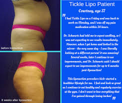 will liposuction help me lose weight