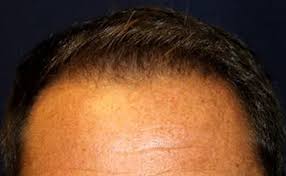 How does it compare to other hair restoration methods? Comprehensive Hair Restoration Process California Hair Md
