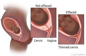 cervical effacement health library