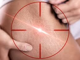 stretch marks removal singapore laser