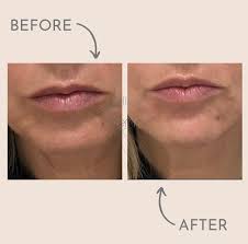 dermal fillers lip enhancement