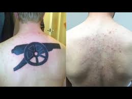 laser tattoo removal does laser