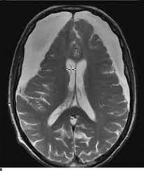 Caused by increased intracranial pressure (icp) which can lead to 4 types of herniation: Subdural And Epidural Hematomas Chapter 19 Toole S Cerebrovascular Disorders