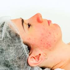 what causes red blotches on the face