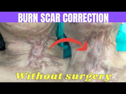burn scar correction without surgery