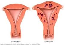 Image result for what is the icd 10 code for adenomyosis