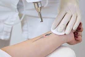 laser treatment for tattoo removal