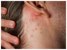 your skin rash is eczema