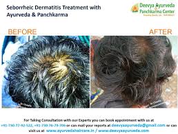 scalp dry dandruff greasy dandruff hair