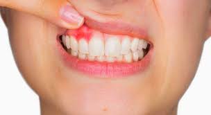 gum disease causes symptoms and