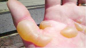 should you pop that blister daily trust