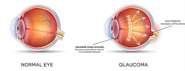 Glaucoma Diagnosis Jacksonville Glaucoma Tests