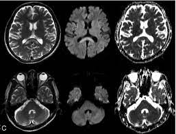 Энцефалопатия головного мозга, что это, причины и симптомы. Rezidualnaya Encefalopatiya Simptomy Prichiny I Osobennosti Lecheniya Medicinskij Portal