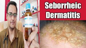 seborrheic dermatis itchy scalp स र