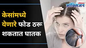 treat acne on scalp hair treatment