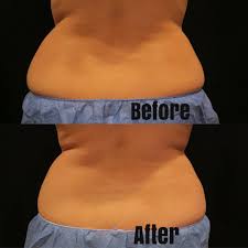 this is the before and after shot of my back love handle view