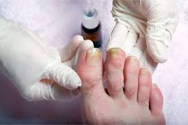 get rid of toenail fungus permanently