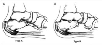 An example of spur is an item that a cowboy wears on his boots. Calcaneal Spurs Physiopedia