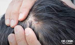 scabs and soreness on the scalp 11 1