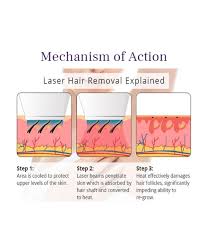 laser hair removal