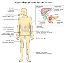 Once the cancerous cells spread in other body parts, it is referred as metastatic pancreatic cancer. Signs And Symptoms Of Pancreatic Cancer Pancreas Grepmed