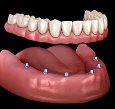 implant dentures missing teeth