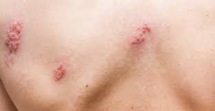 herpes zoster shingles treatment