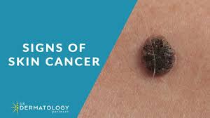 Most types of cancer are diagnosed with the help of a biopsy—a sample of potentially diseased tissue. Skin Cancer Screening Symptoms Types Warning Signs Youtube