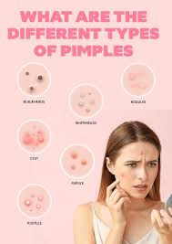 get pimple free skin at home using