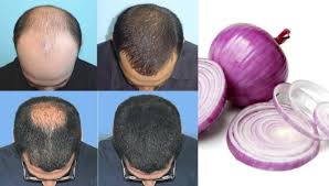 onion juice for hair growth myths facts