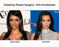celebrity plastic surgery 31 before