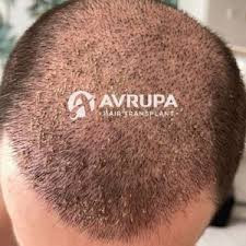 remove scabs after hair transplant
