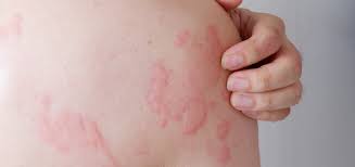 hives dermatology and skin health