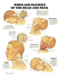 Amazon Com Whiplash Injuries Of The Head And Neck Laminated