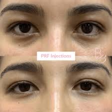 try prf under eye treatments
