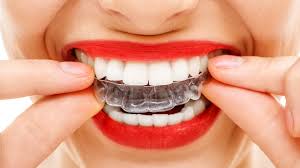 But how do you tell whether your teeth could really benefit from braces? How Long To Wear Retainers After Braces Straight Teeth