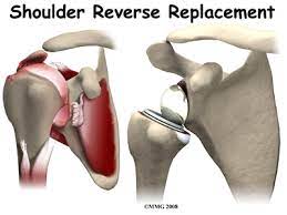 reverse shoulder arthroplasty