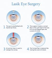 what does lasik eye surgery feel like